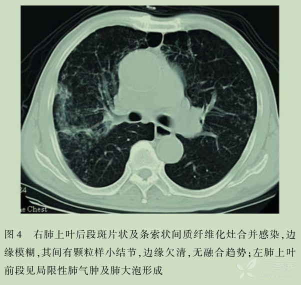 支气管痰栓,气管支气管,空气支气管征(第4页)_大山谷图库
