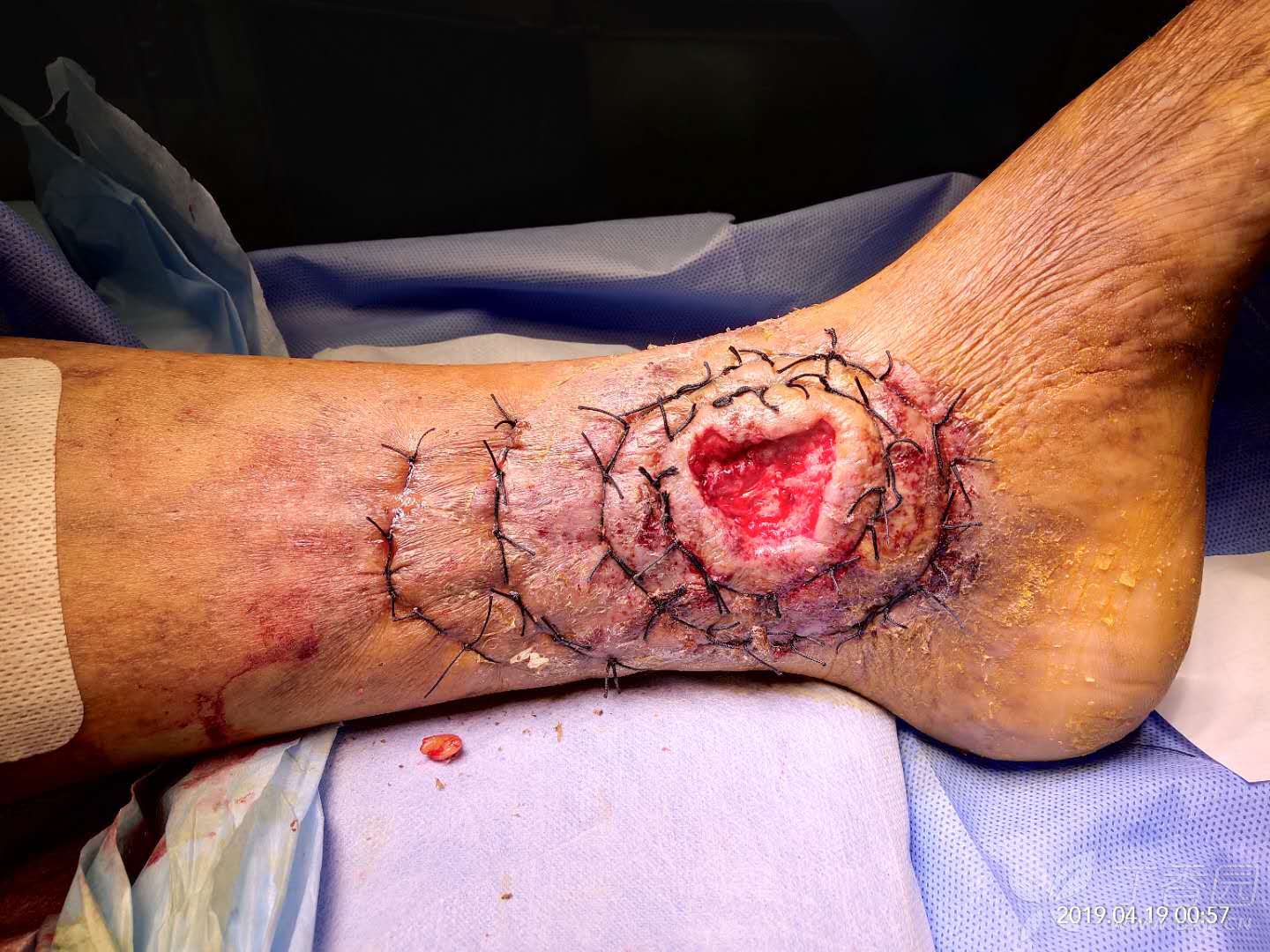 下肢静脉性溃疡环形缝合,效果咋样? - 普通外科 - 专业医生社区,医学,