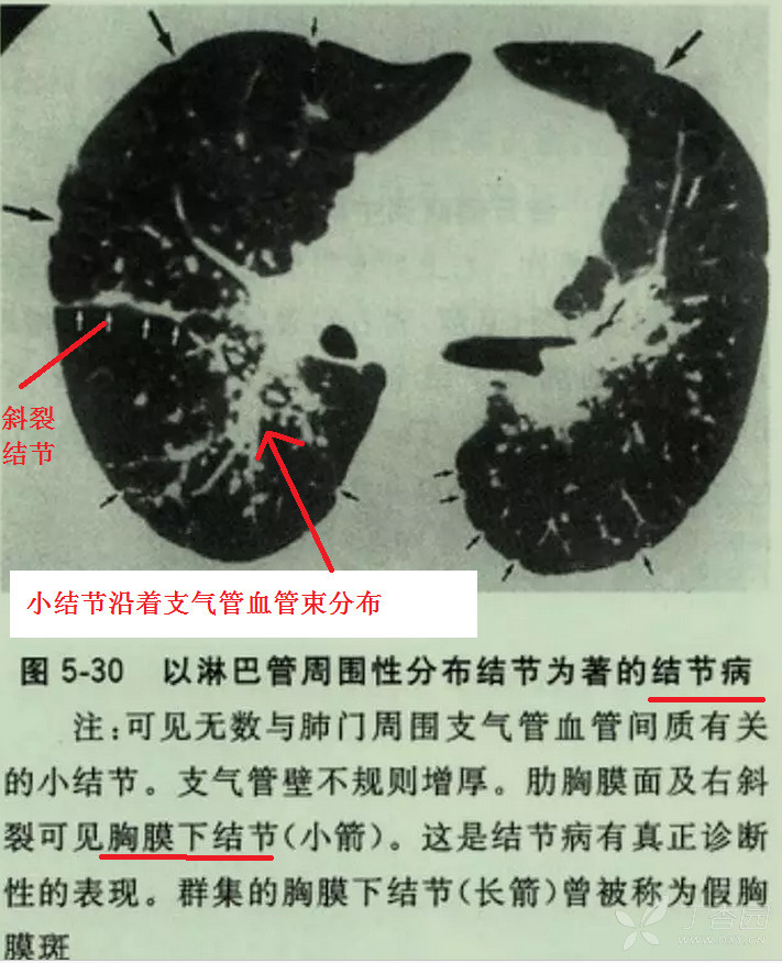 支气管痰栓,气管支气管,空气支气管征(第4页)_大山谷图库