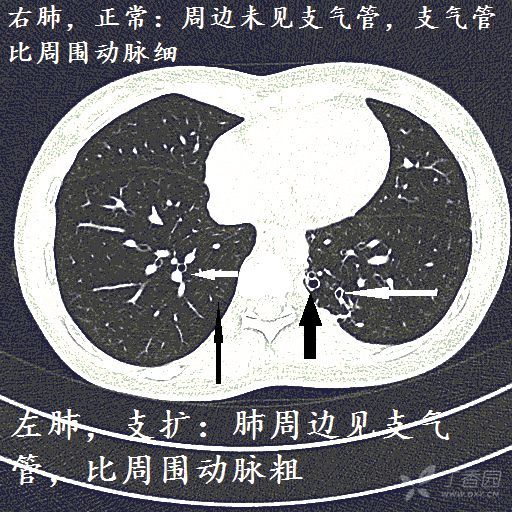 支气管扩张的表现图片