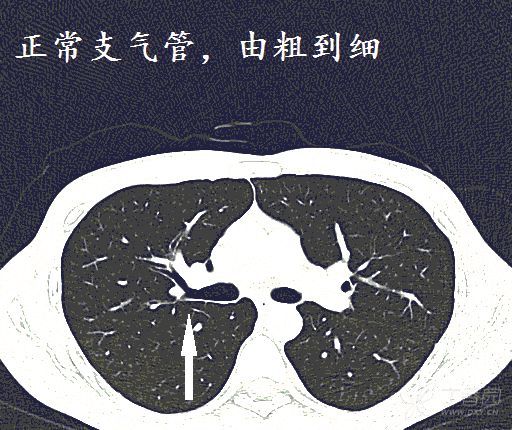 经典图谱,详细解说支气管扩张ct小诀窍:学不会我拜你为师!