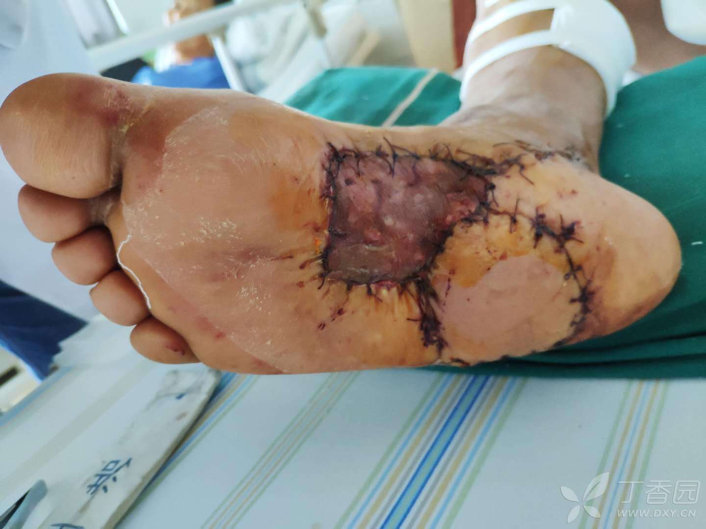 恶性黑色素瘤,截肢or保肢?