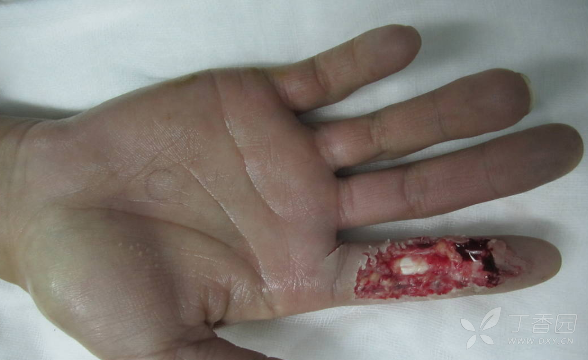 跟一例:第2掌背动脉皮瓣