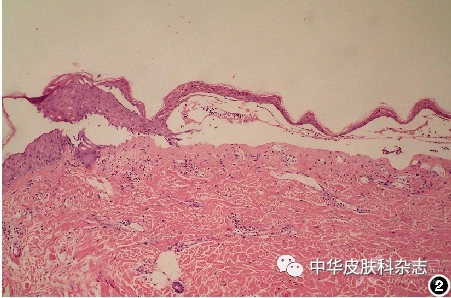 火激紅斑是由長期反覆暴露於不足以引起燒傷的熱源導致的網狀青斑樣