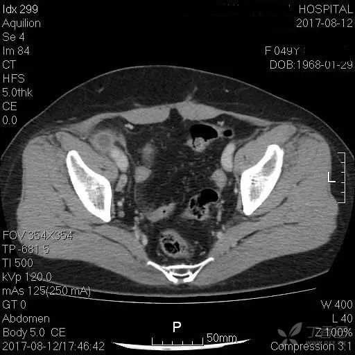 阑尾炎的诊断,需不需要ct证实?