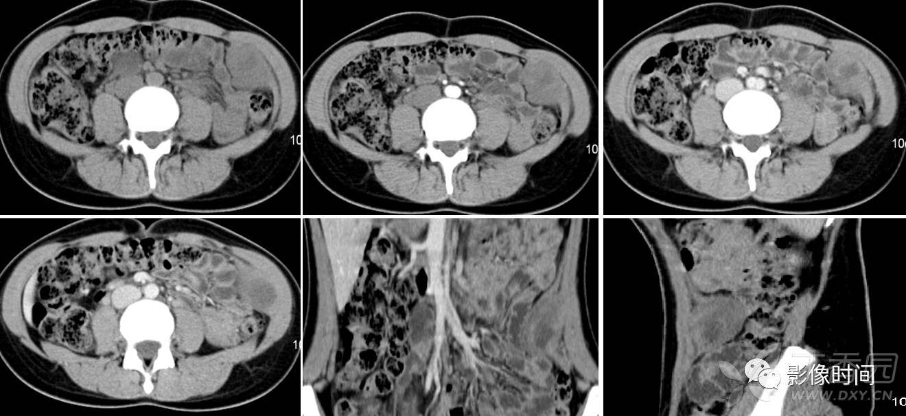 优质一例韧带样纤维瘤,您有见过么?