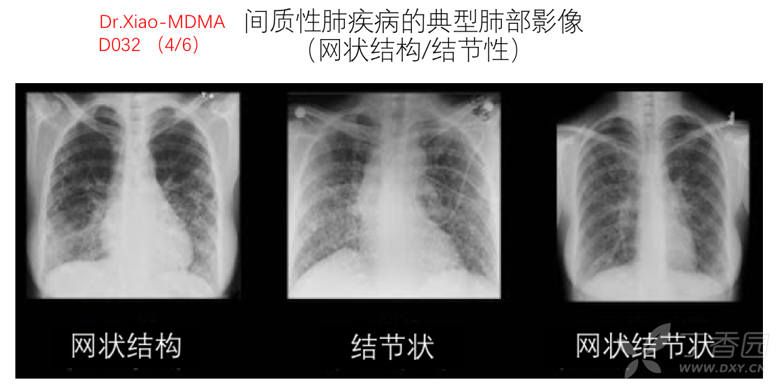 間質性肺疾病典型纖維化ct表現(蜂窩狀改變)