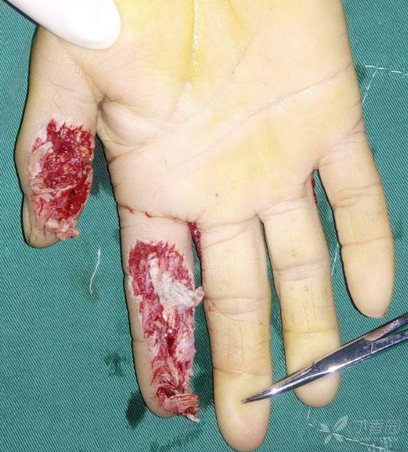 【讨论】分享一例掌背动脉皮瓣