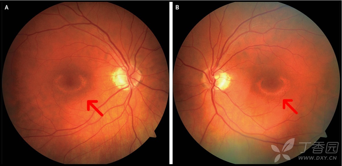 急救与危重病讨论版视野检测示 环状盲点,视网膜 光学断层成像提示 光