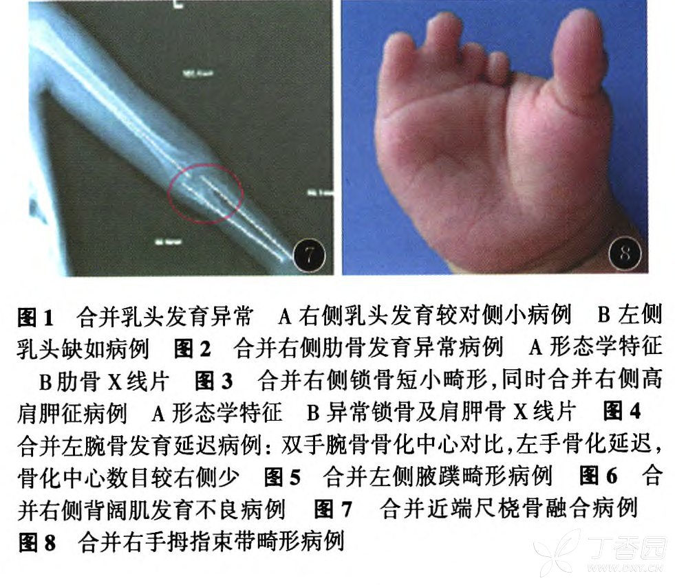 前来公布答案:poland综合征 这个患者的胸壁,肩胛肌群缺失的如果能