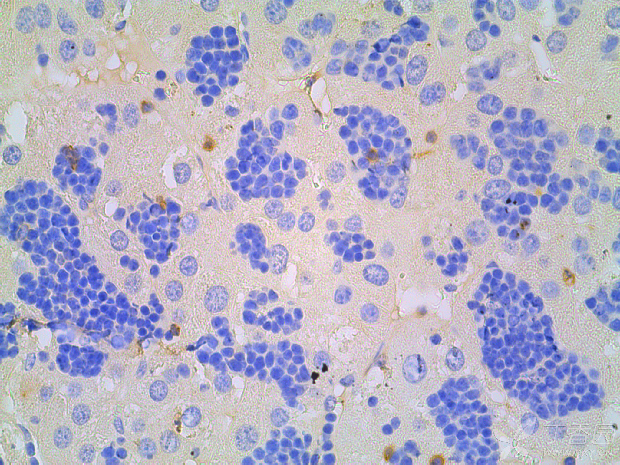 了小鼠肝癌模型,然后取小鼠肝脏肿瘤行he, ki-67以及beta-catenin染色