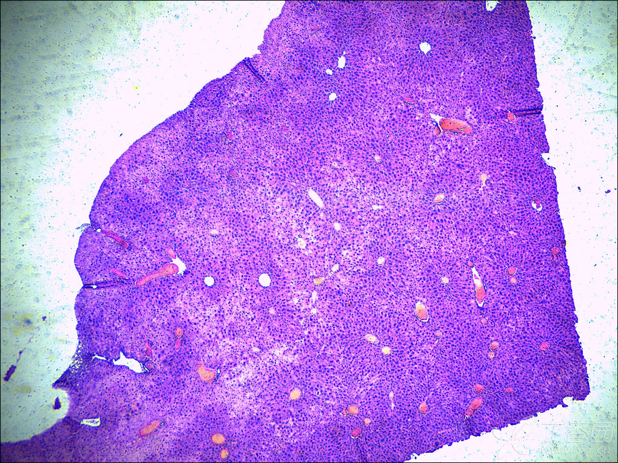 肝细胞假小叶图片