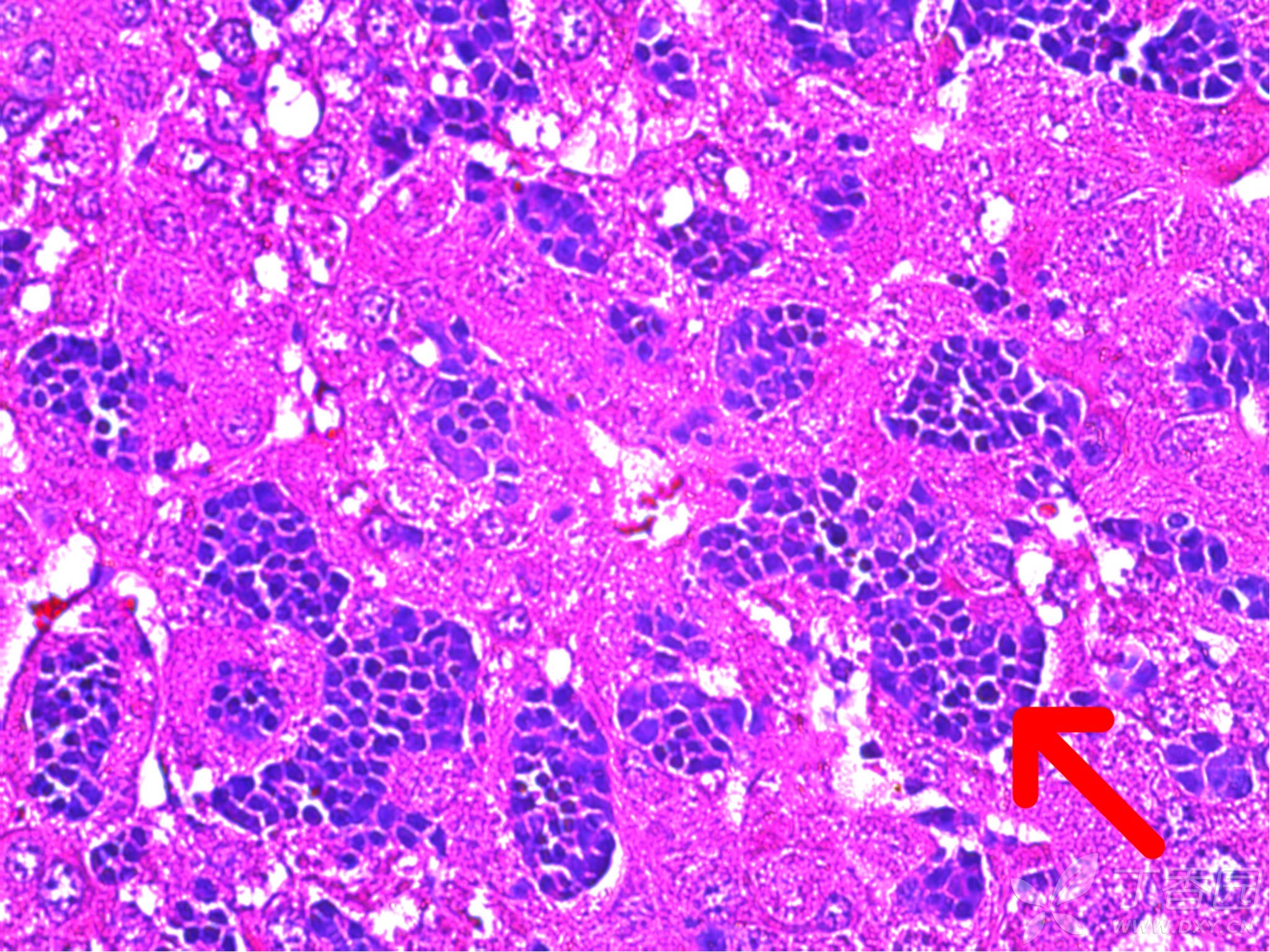然后取小鼠肝脏肿瘤行he, ki-67以及beta-catenin染色