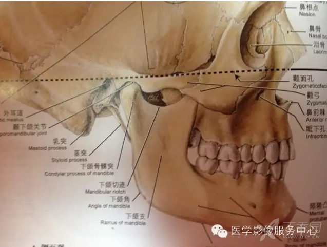 茎突过长或茎突舌骨韧带钙化均可引起咽部症状