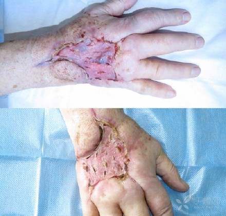 手背蜂窝织炎的清创植皮过程 - 丁香园论坛