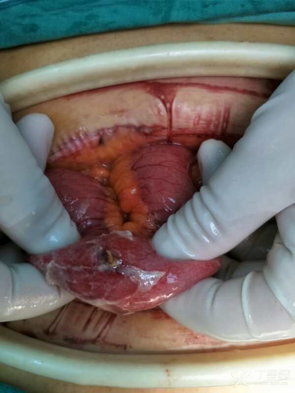 其中我自己就做了有5,6例,都是老年人,其中一例是直肠穿孔(靠近腹膜反