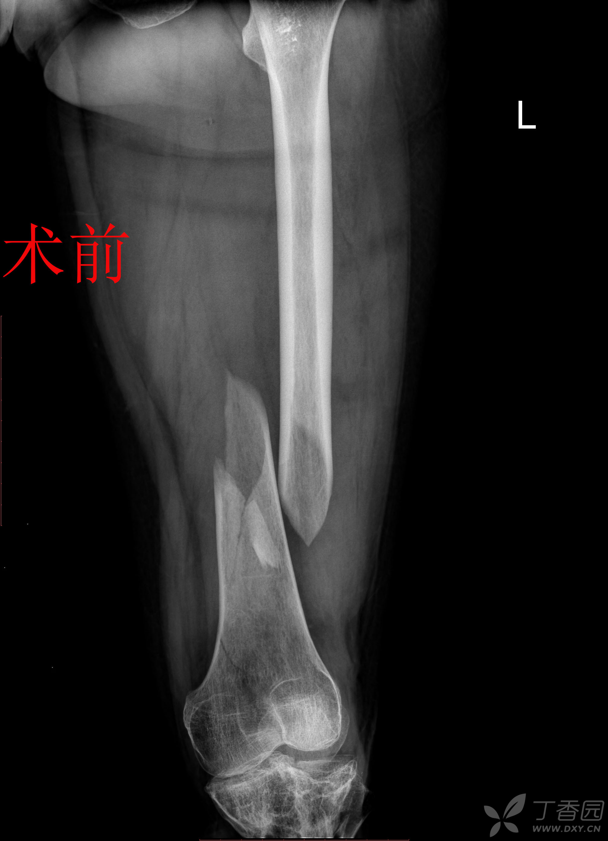 股骨远端骨折锁定钢板固定术后14月骨不连 影像资料清晰 连贯 请老师们多指点 骨科专业讨论版 丁香园论坛