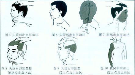 大出血几分钟就可危及生命 急救止血措施有必要学起来 丁香园blog 丁香园论坛