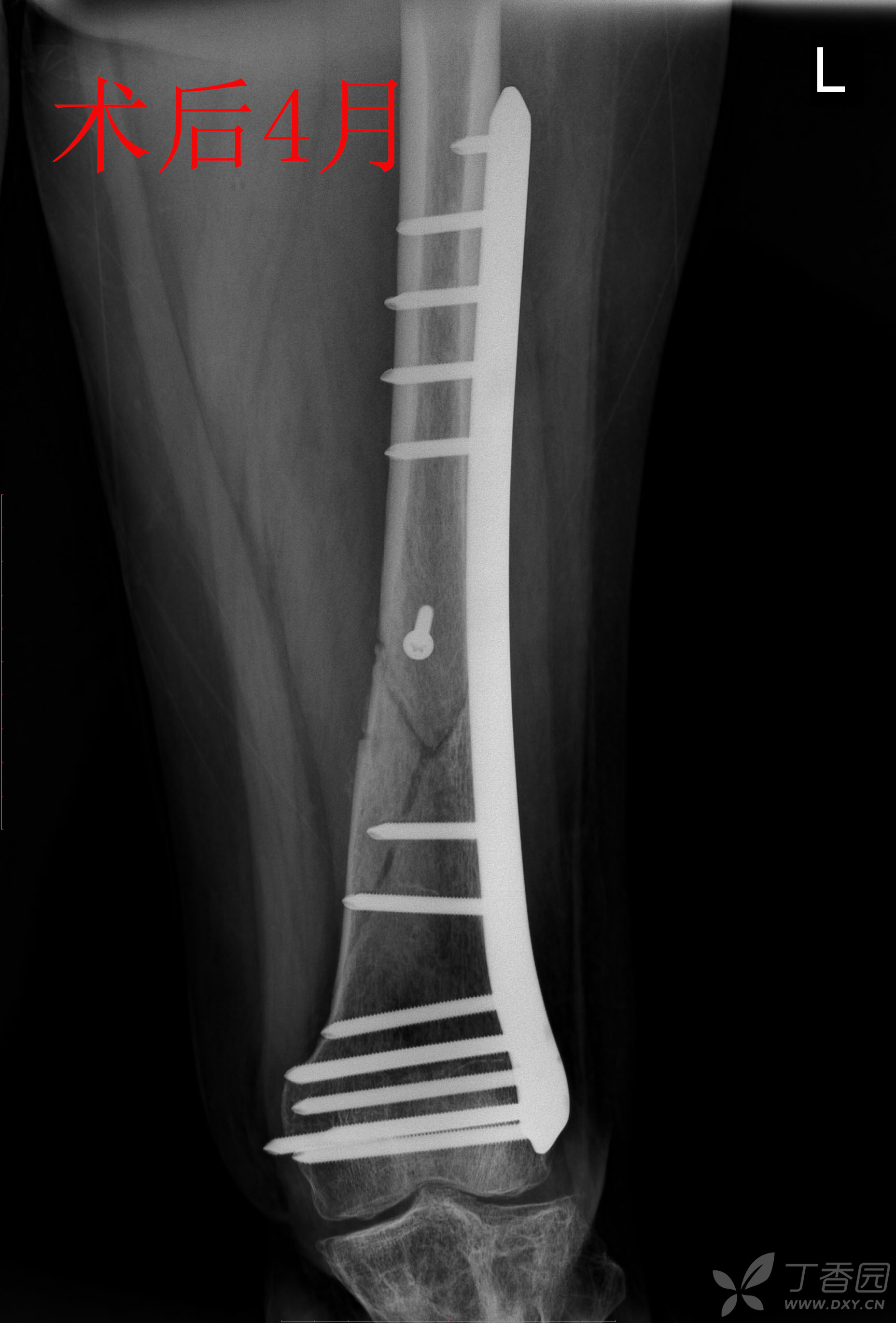 股骨远端骨折锁定钢板固定术后14月骨不连 影像资料清晰 连贯 请老师们多指点 骨科专业讨论版 丁香园论坛