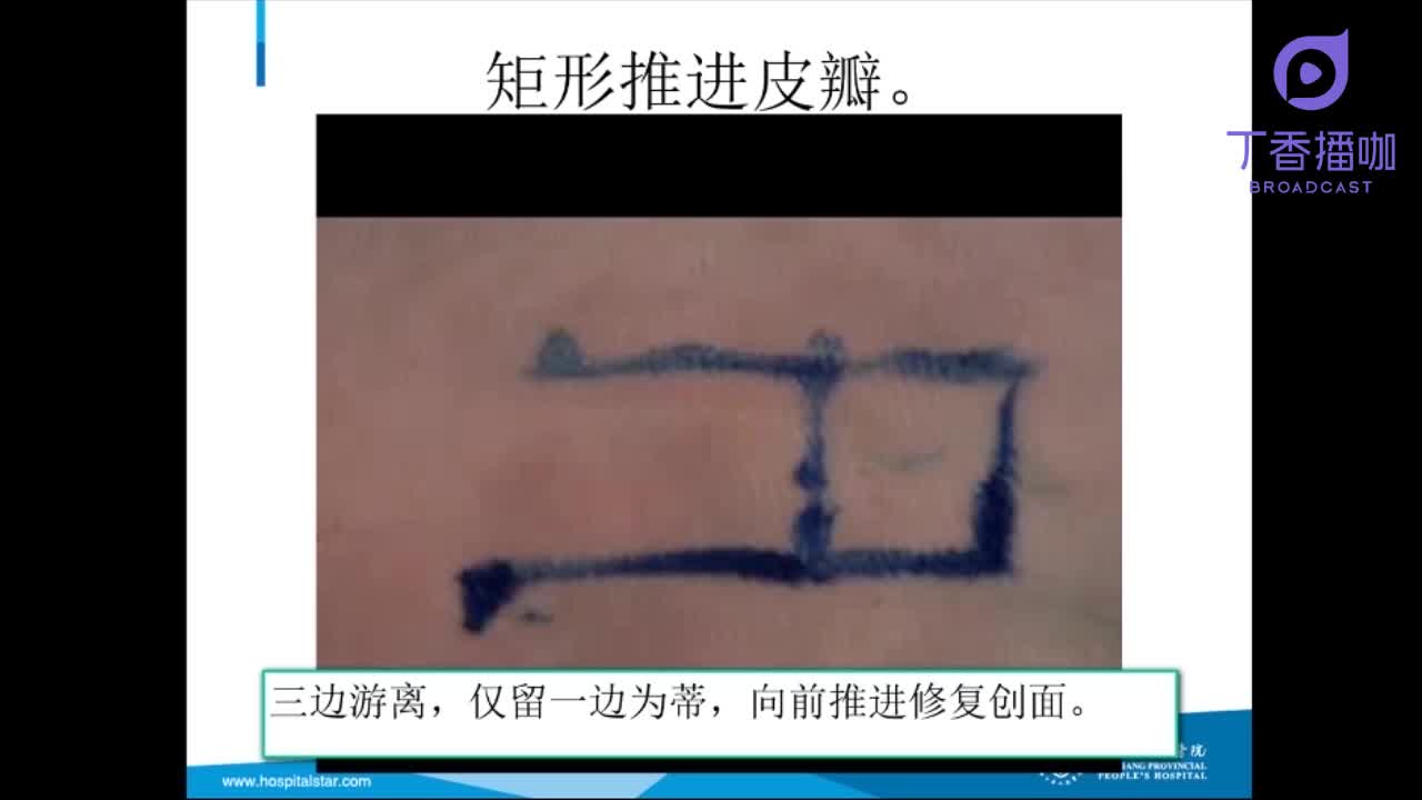 【讲座】术式讲解 | 矩形推进皮瓣修复术