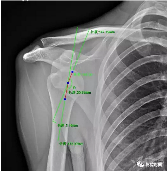 切换新版 >> 不再显示 × 肩关节间隙  4 mm 肱骨颈干角 肱骨干中线