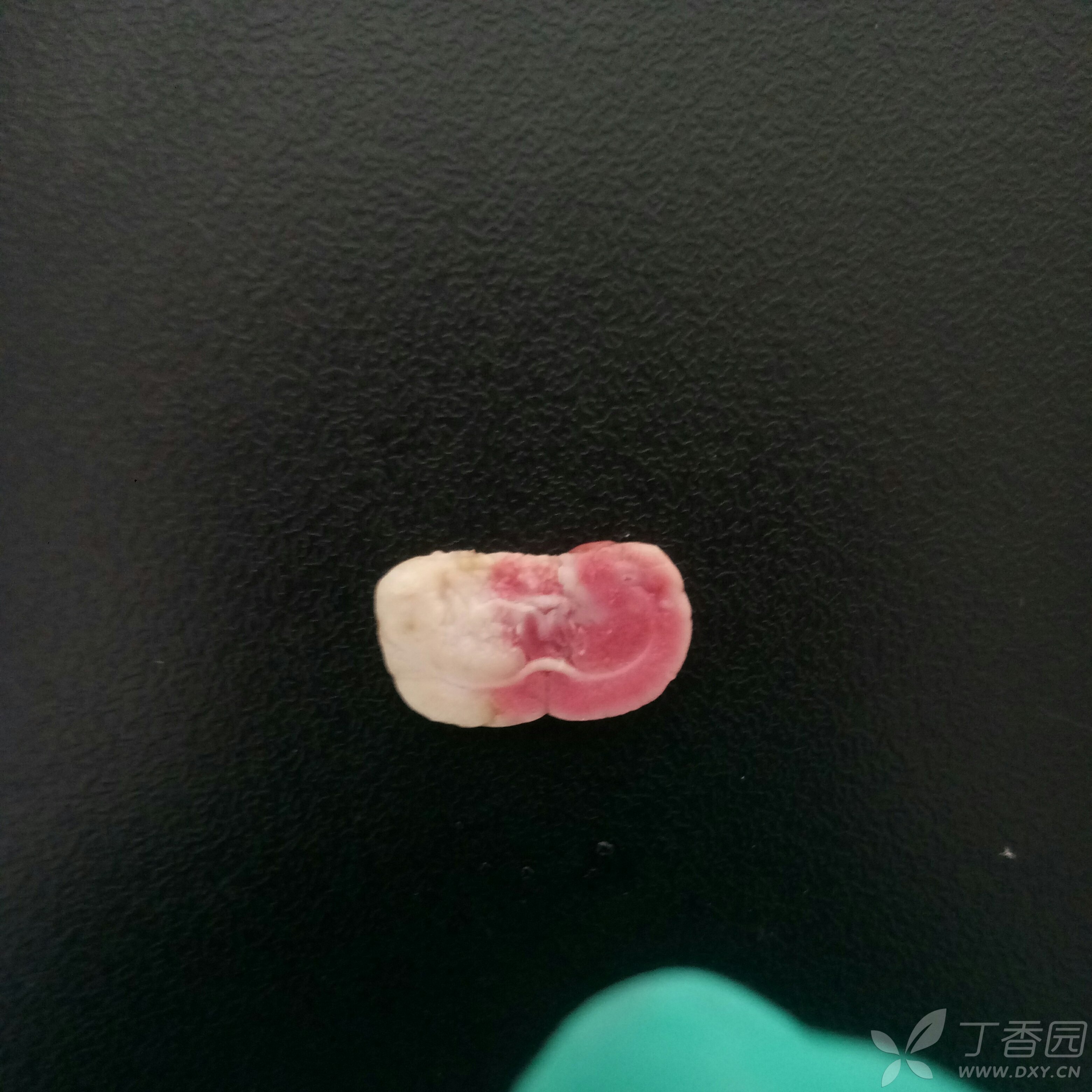 求助:ttc染色后脑片正反面梗死大小不一,该以那一面为准?