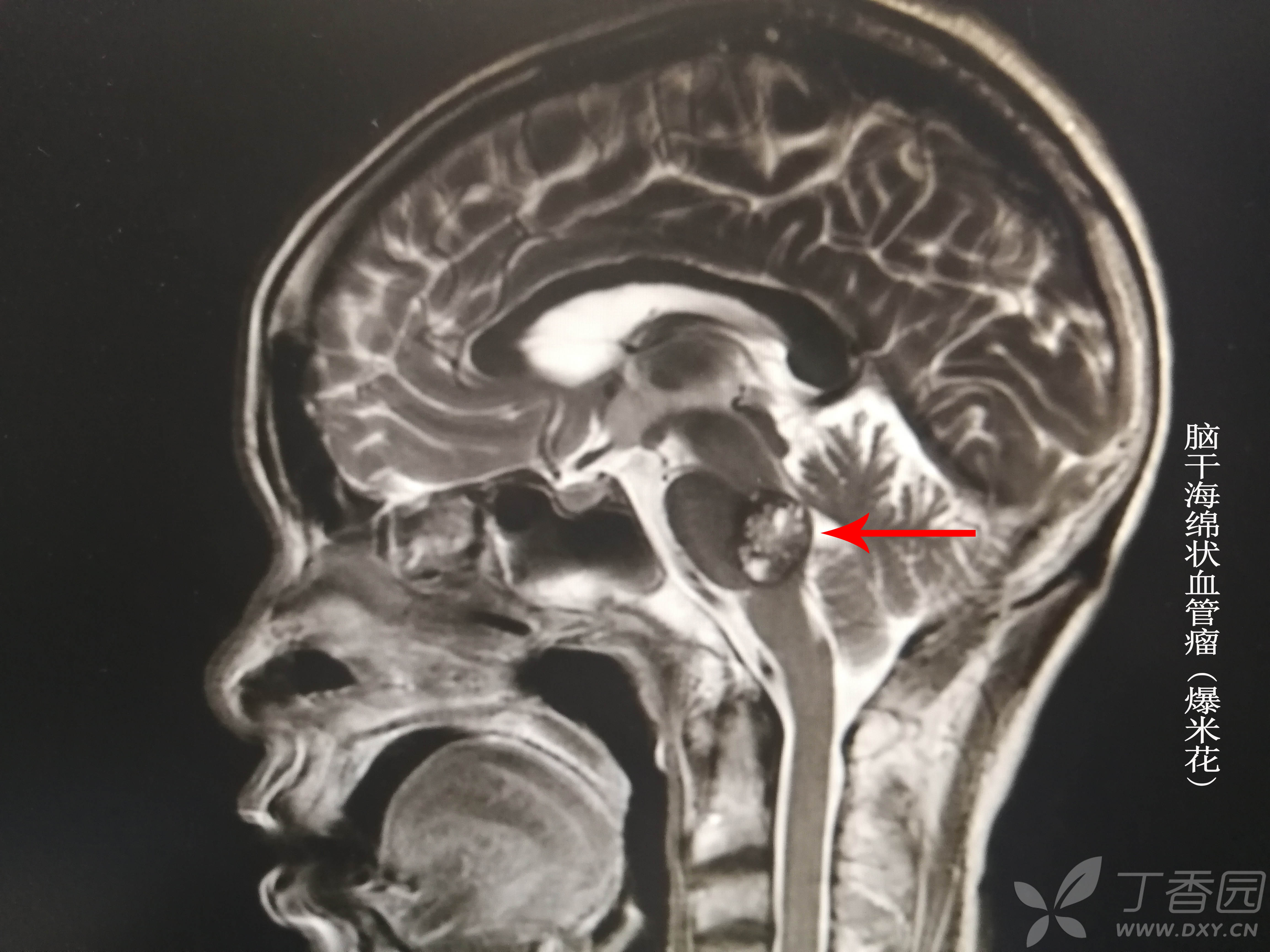 典藏的脑海绵状血管瘤典型影像