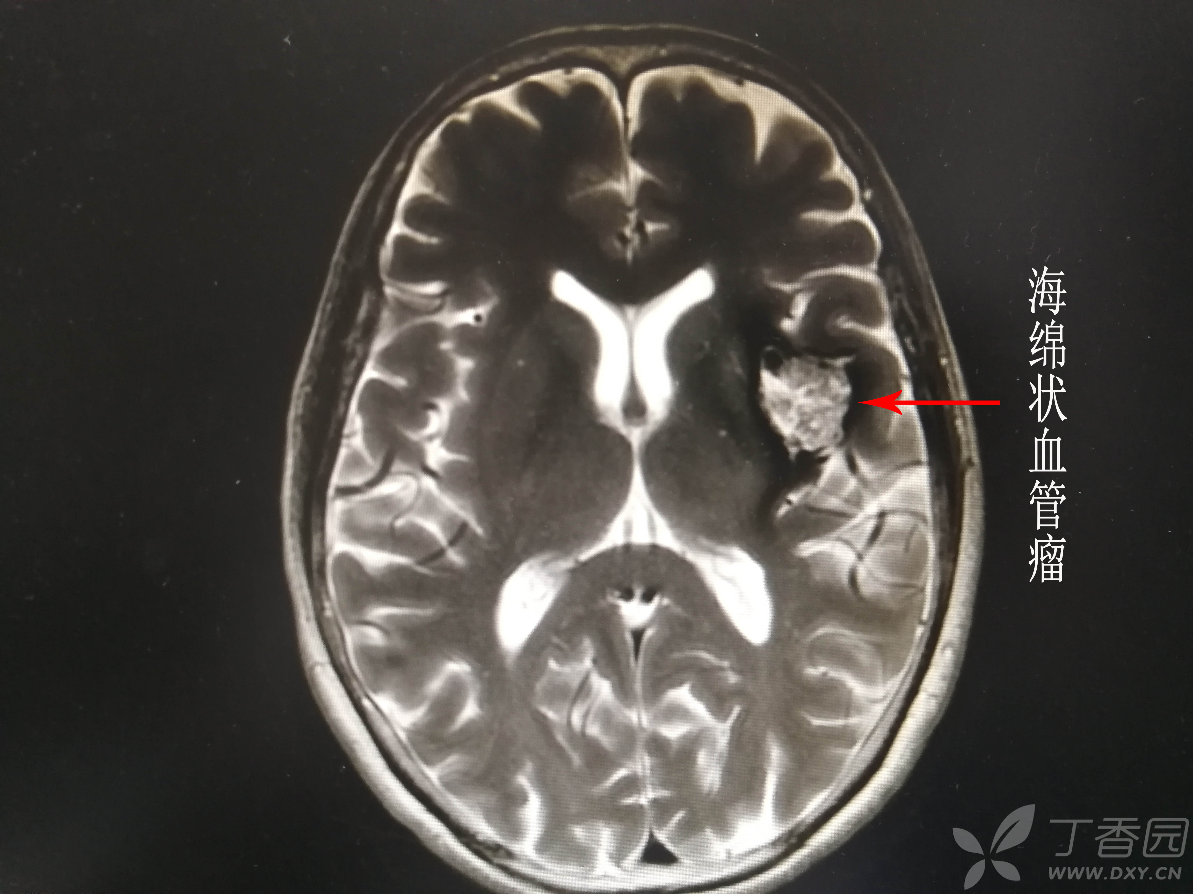 脑海绵状血管瘤10mm图片