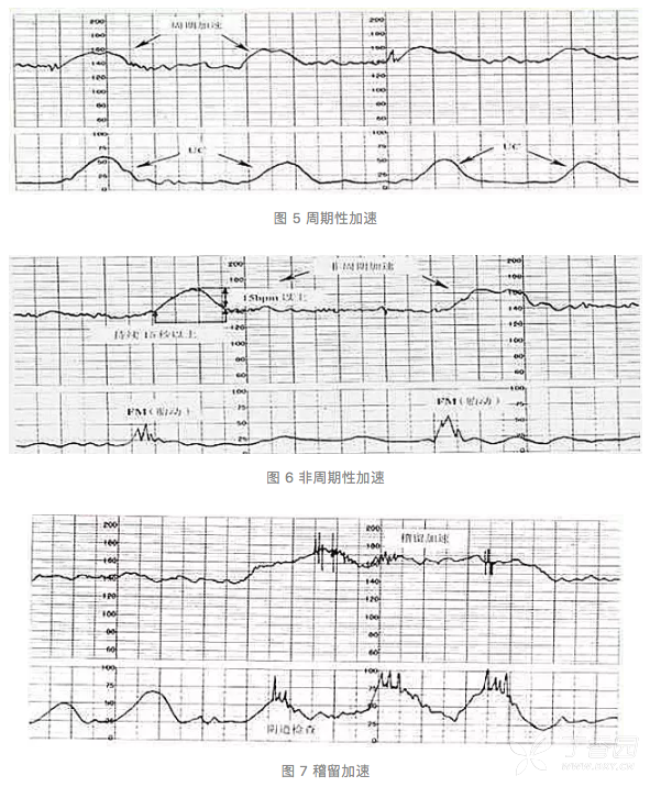 胎心监护变异减速图片