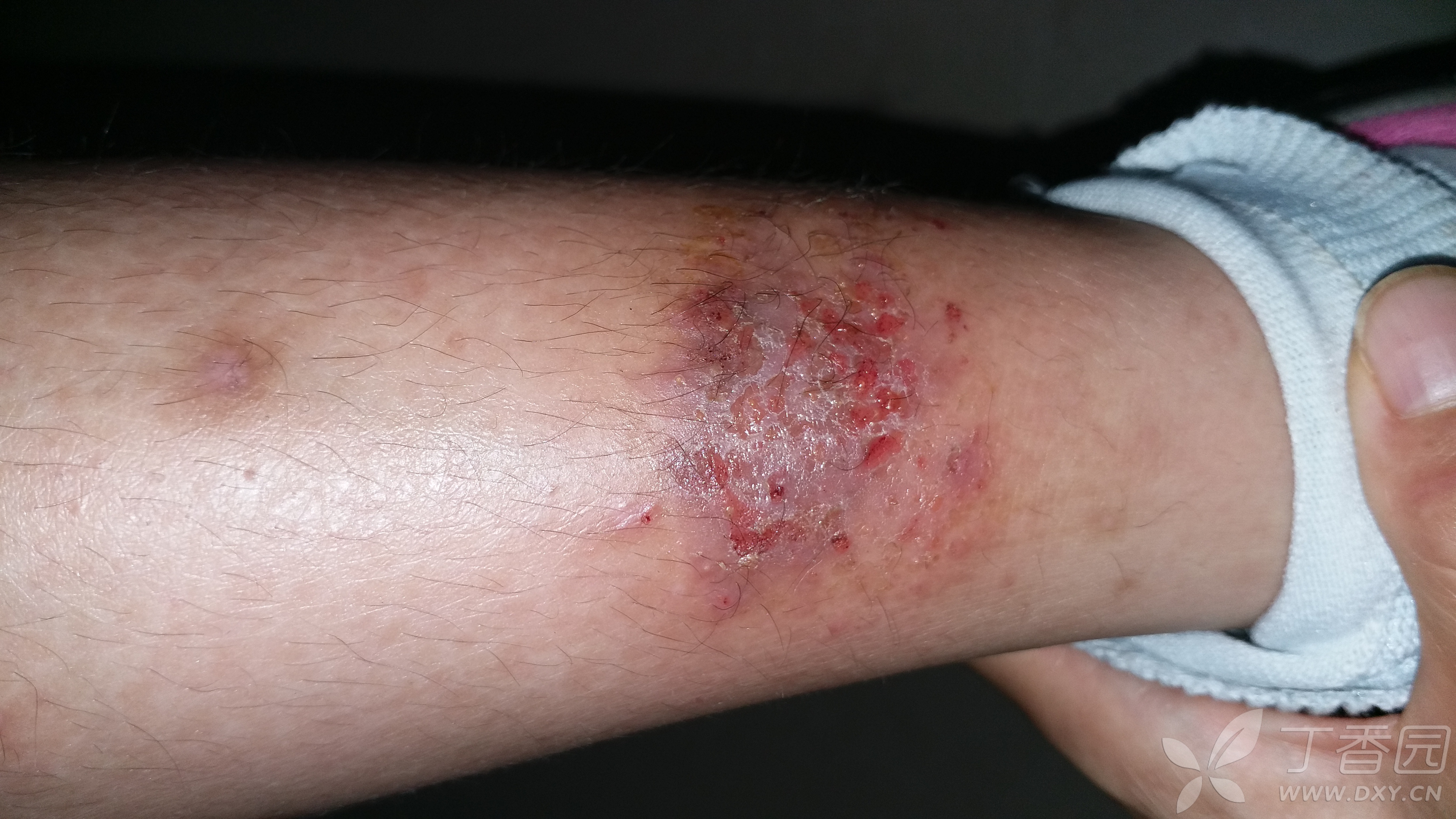 过敏性湿疹合并溃烂,怎么办