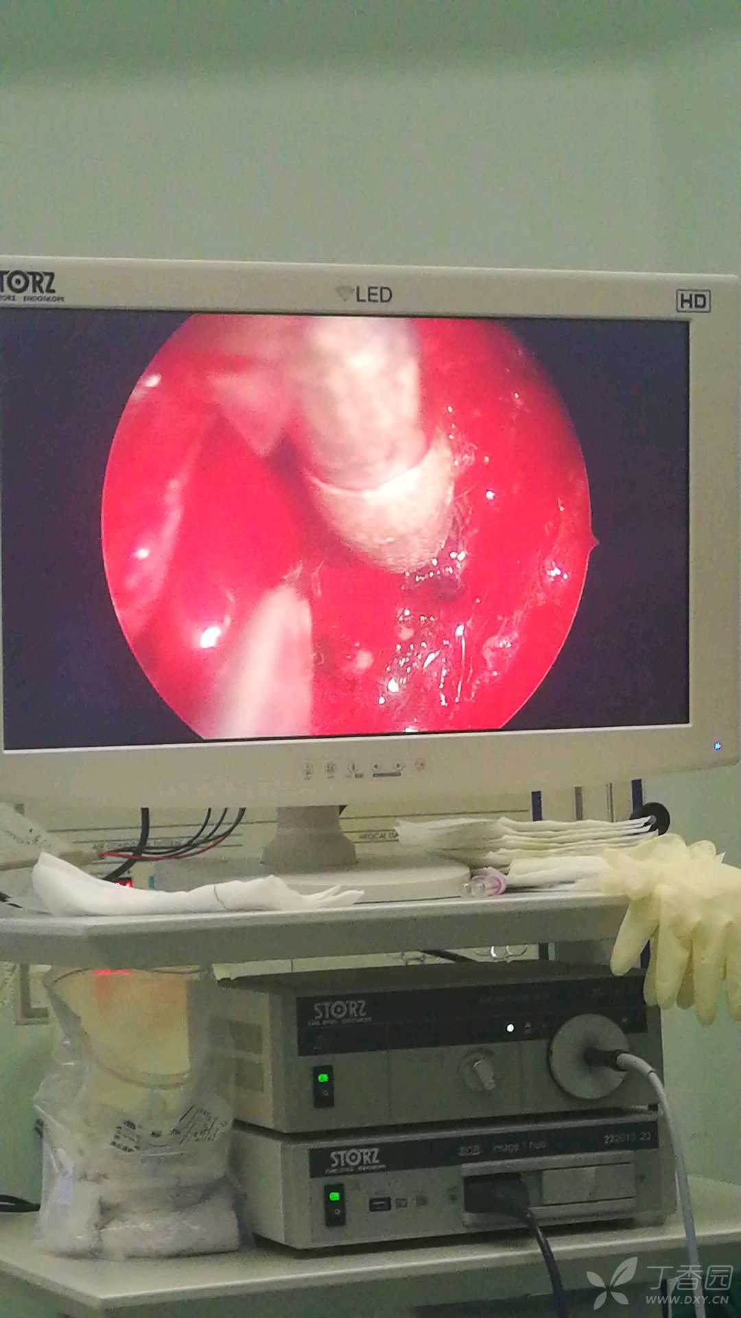 前庭大腺脓肿切开术图片