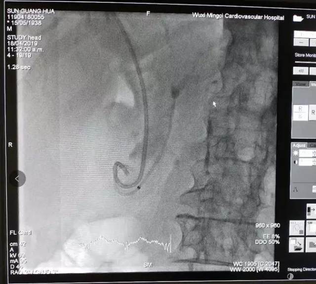 「镜」厉害的！40 分钟成功实施 ERCP 手术
