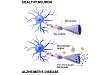 High performance plasma amyloid-β biomarkers for Alzheimer’s disease