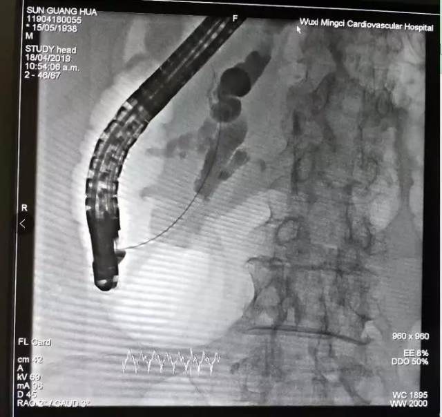 「镜」厉害的！40 分钟成功实施 ERCP 手术