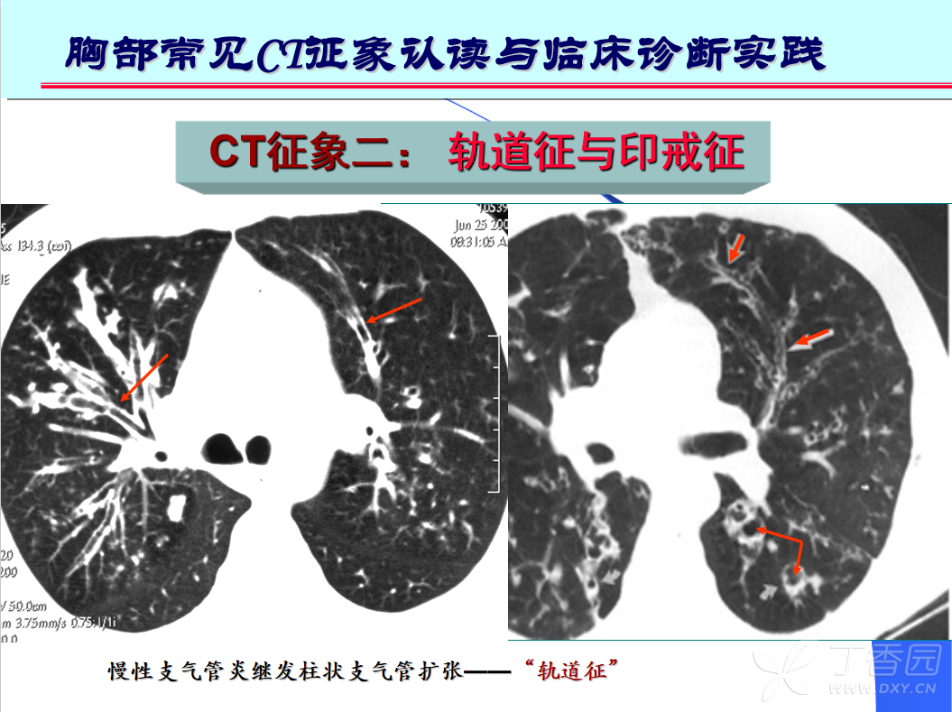 2,"印戒征":扩张支气管与ct扫描层面垂直时   (正常同级别的肺动脉