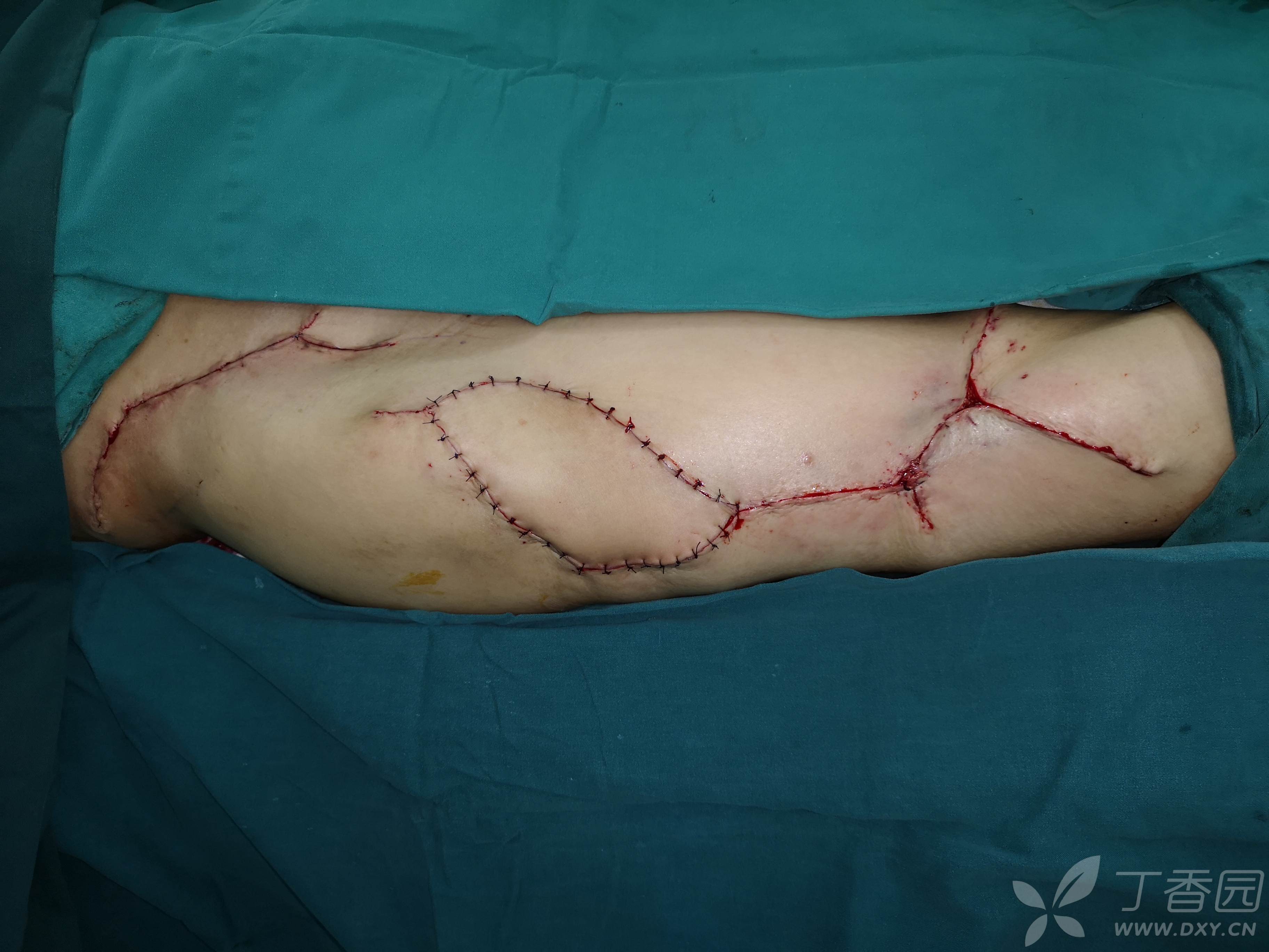 【讲座】vlog14旋髂浅动脉筋膜蒂皮瓣-股前外侧皮瓣系列(3/3)