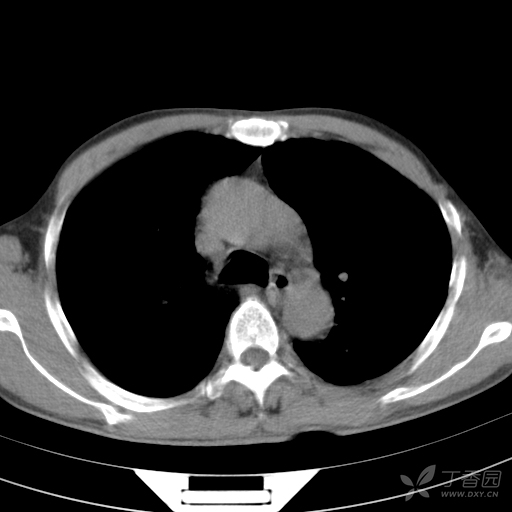 膈肌CT图片