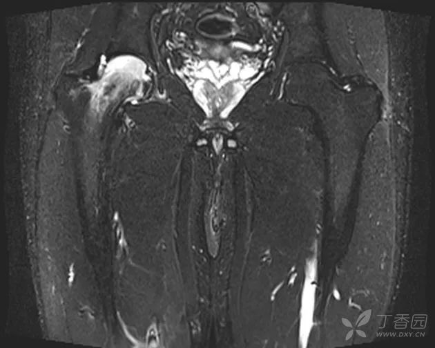 髋关节剧痛   mri 提示骨髓水肿   半年内完全自愈