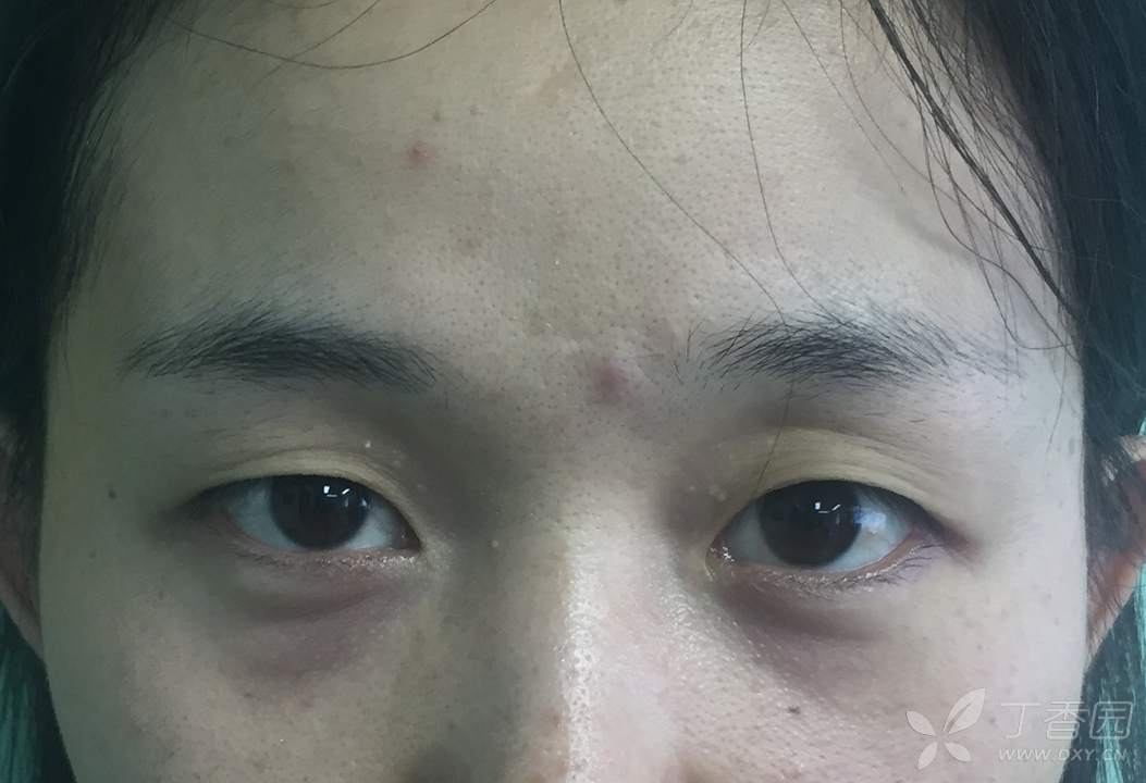 【讨论】再谈:眼轮匝肌肌瓣(注意:眼轮匝肌瓣,用这个词是错误的)的