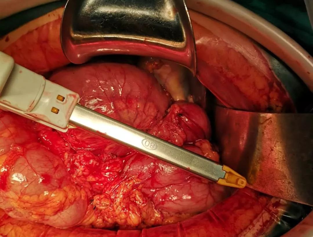 ③离断胃十二指肠动脉: ④离断胰腺颈部: ⑤切除钩突