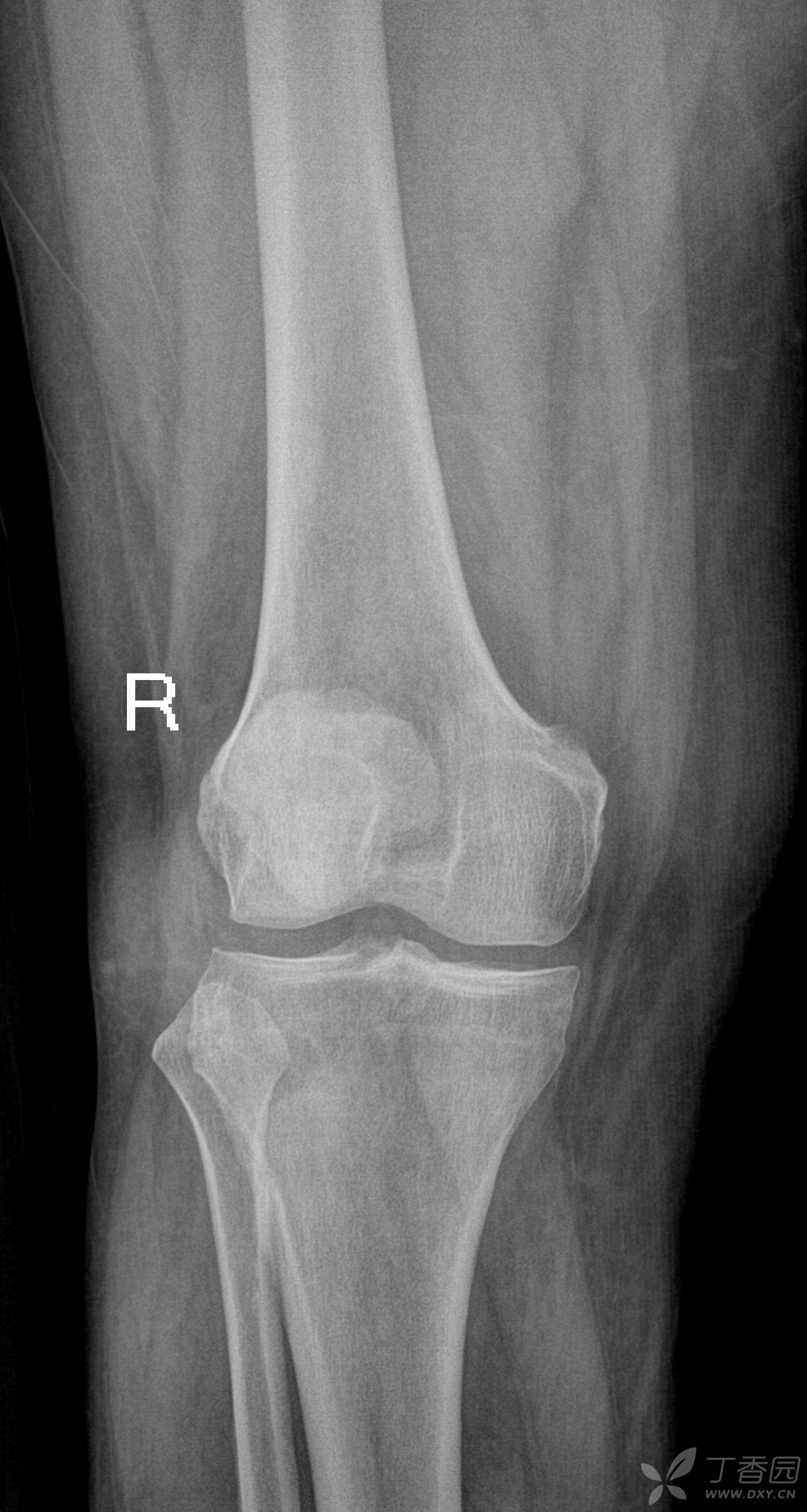 一例典型骨梗死影像表现 - 丁香园论坛