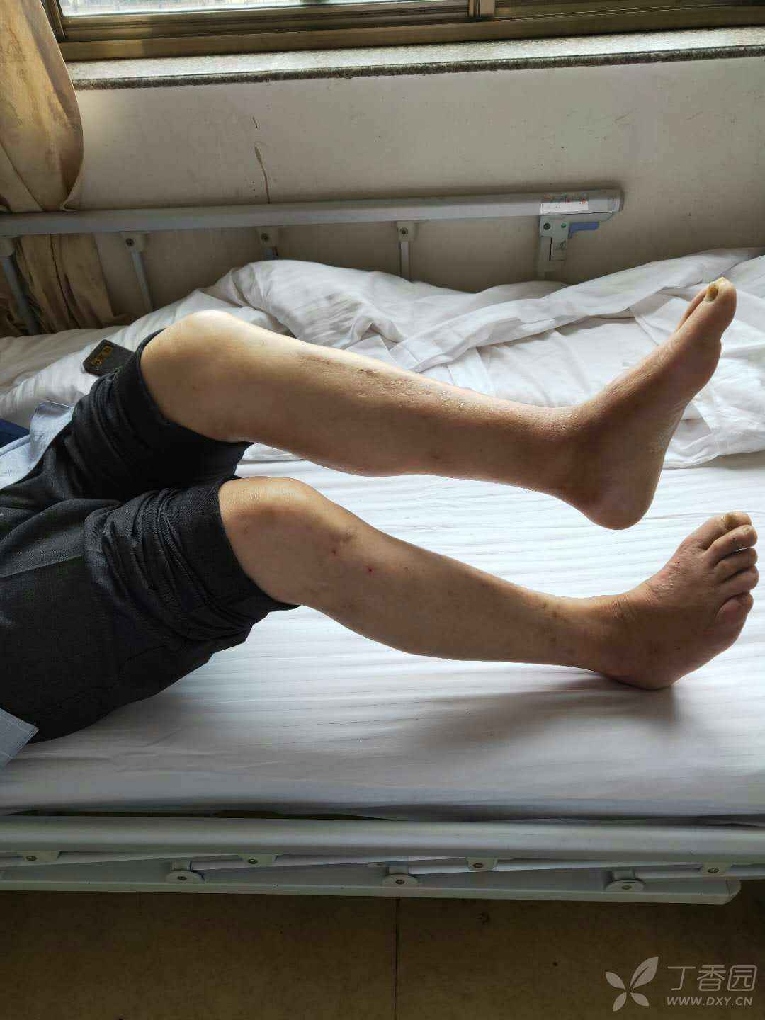 请教:关节僵硬,强直病案一例的诊疗,求大神赐教诊断及治疗.