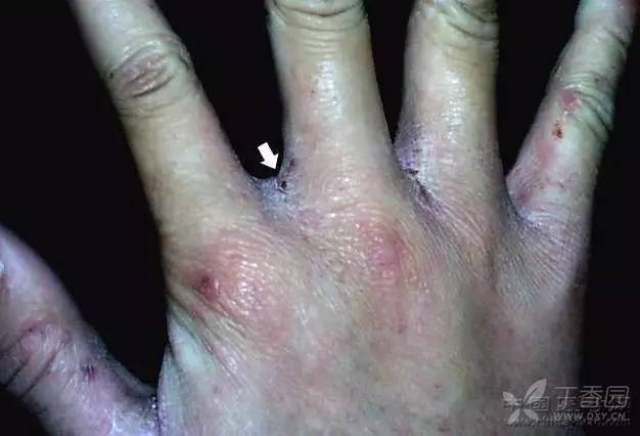 皮肤性病图谱 - 皮肤性病 -丁香园论坛