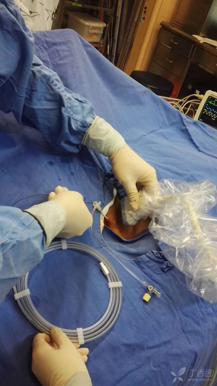 锁骨下静脉穿刺置管术图片