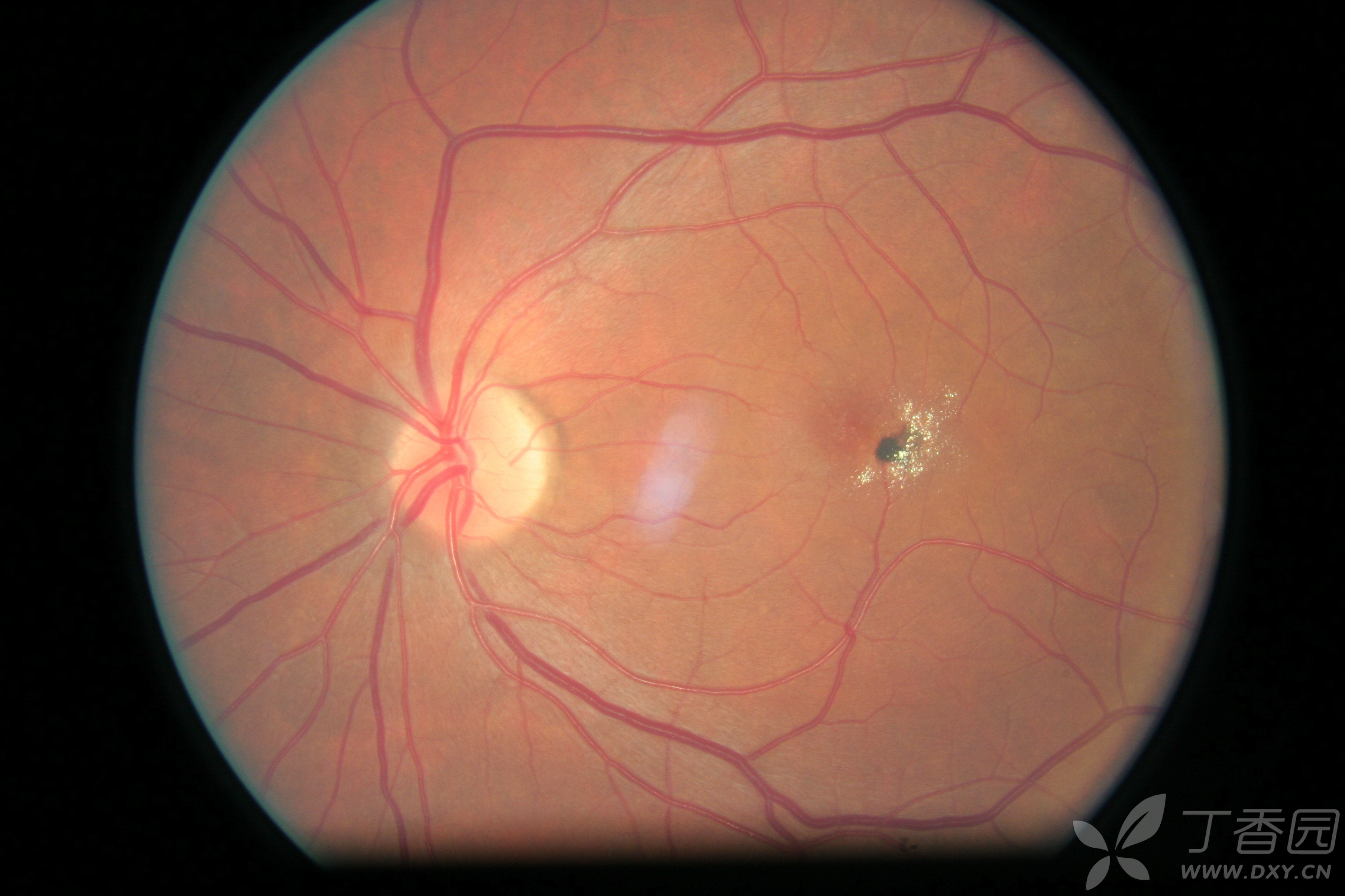 求眼科大神看一看这个眼底,圆形出血病灶周围有点状硬性渗出,是血管瘤