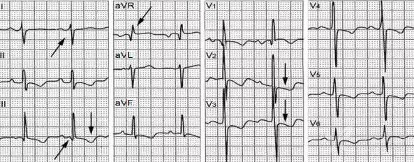 肺动脉栓塞心电图图片