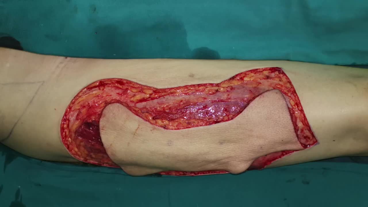 整形与修复方向:即刻牵张技术关闭皮瓣供区-腹股沟皮瓣【解说字幕】