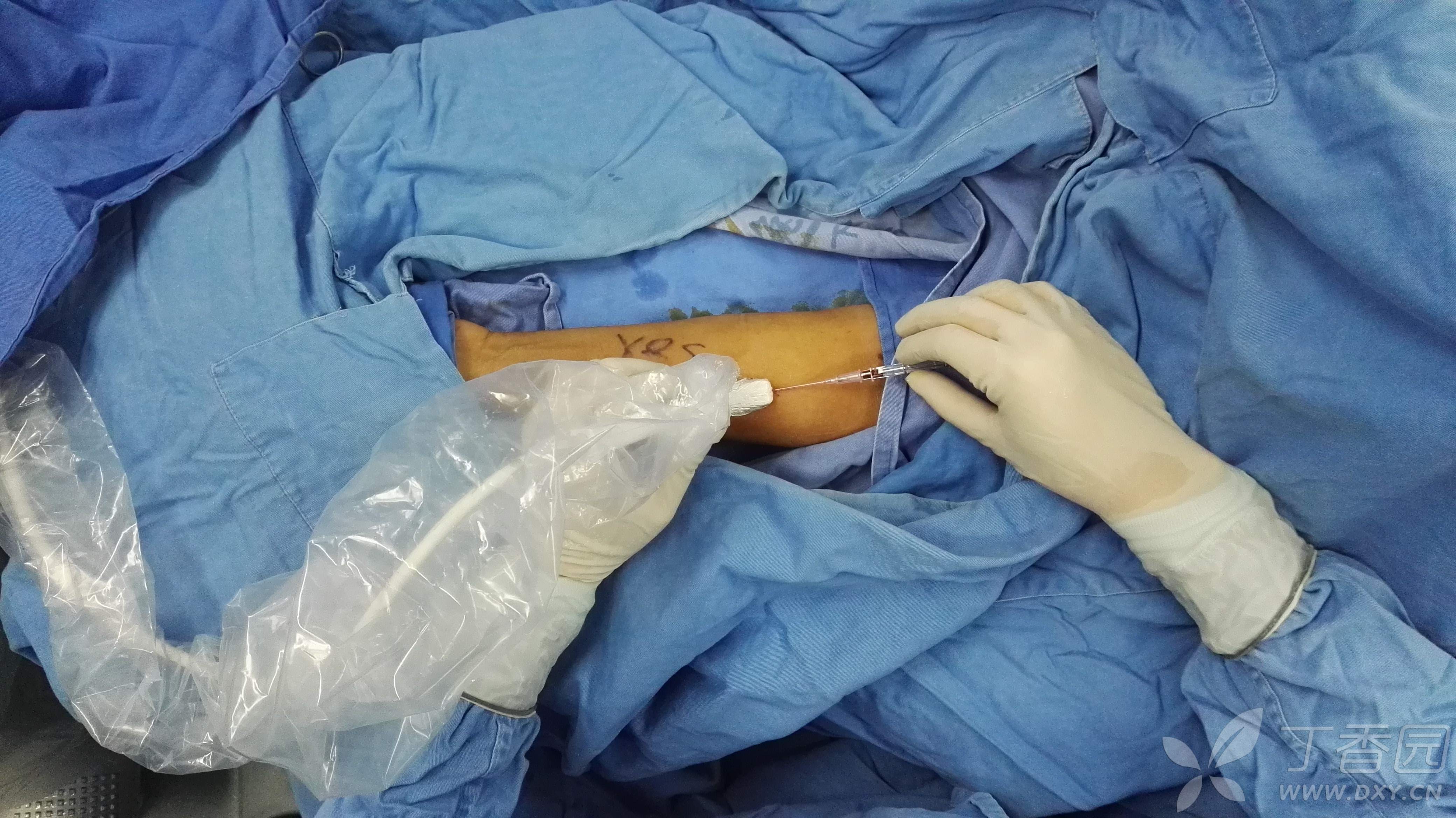 超声引导下内瘘血管穿刺 - 丁香园论坛