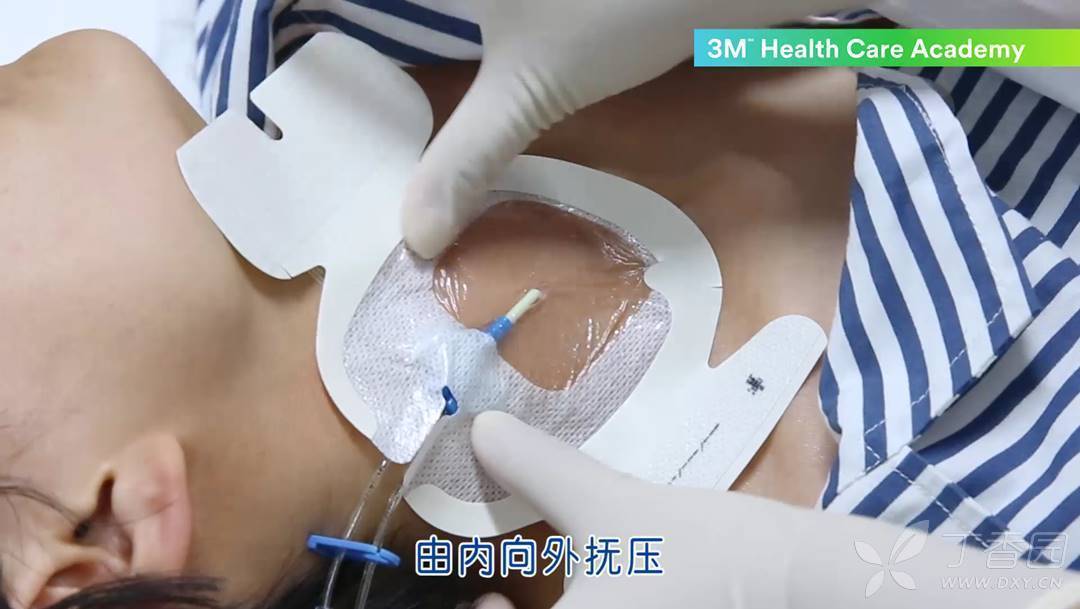 cvc 导管护理要点一次过