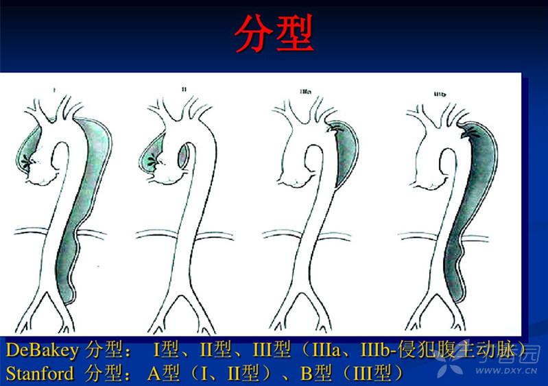 debakey分型图片